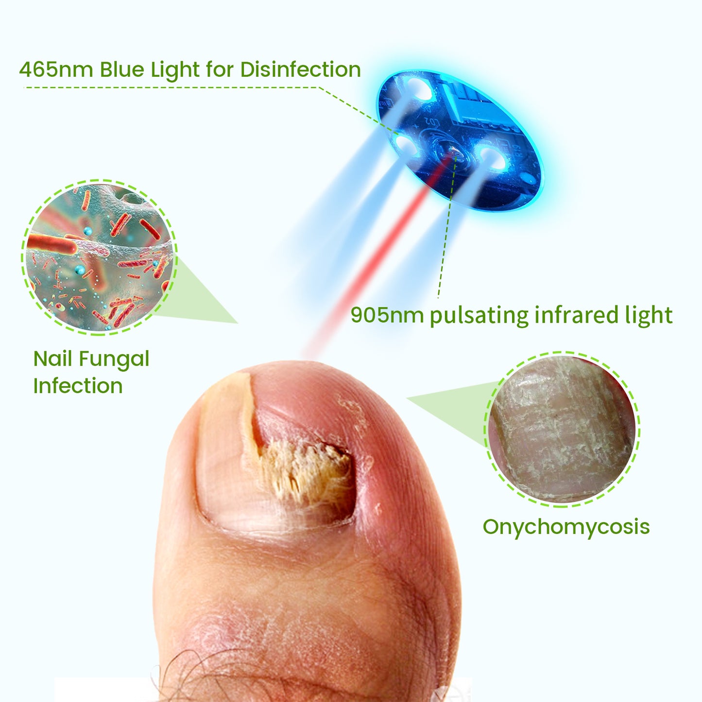 pinfriy® Nail Fungus Laser Treatment Device for Onychomycosis