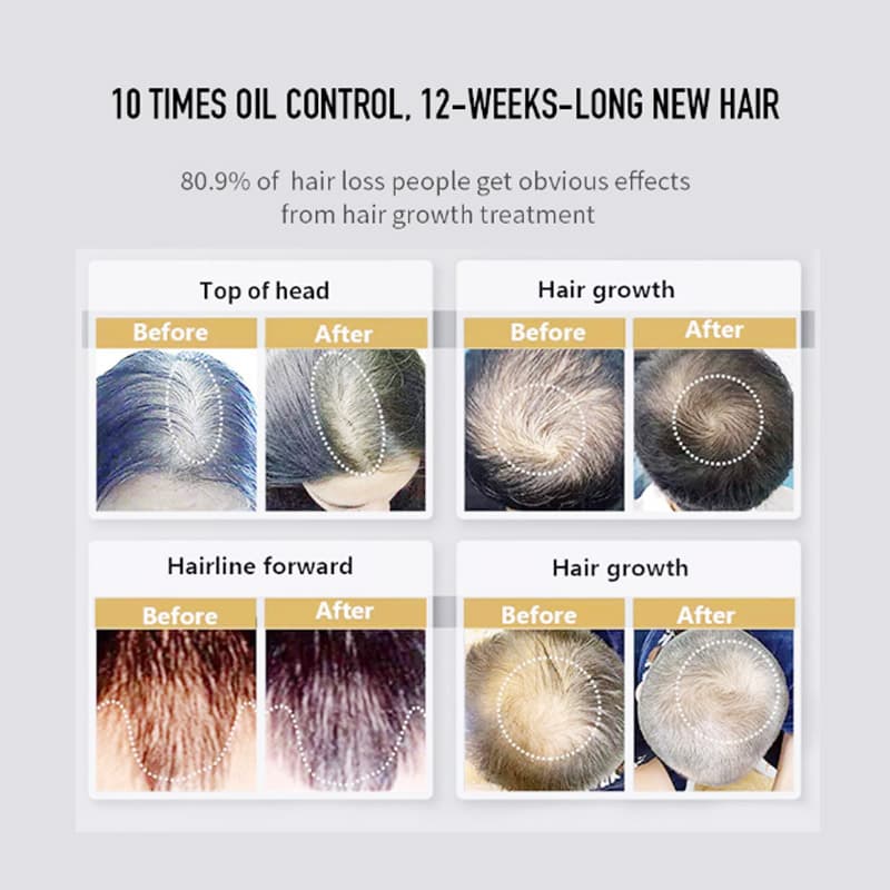 Pinfriy® Hair Growth Laser Cap