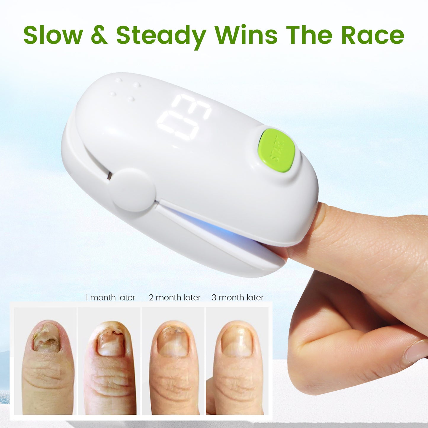 pinfriy®  Nail Fungus Laser Treatment Device for Onychomycosis